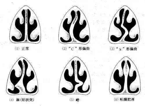 成都鼻中隔偏曲的危害有哪些?