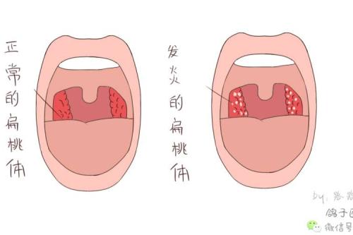 扁桃体发炎的原因是什么?
