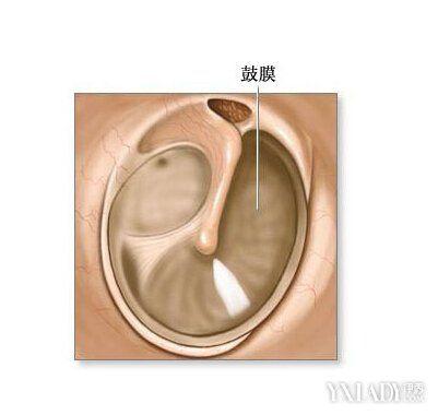 耳膜穿孔后什么情况下需要治疗?