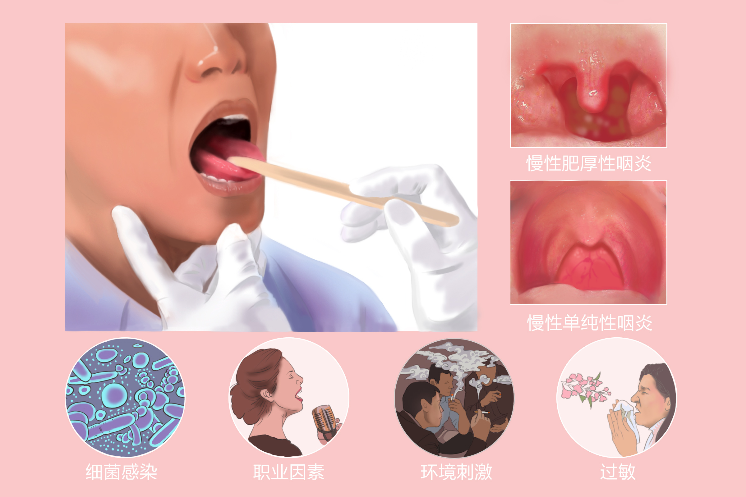 慢性咽炎的常见病因有哪些‘?