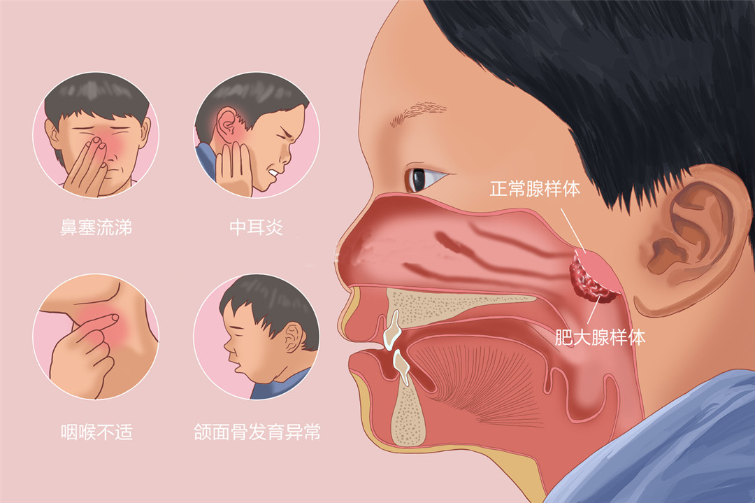 成都小儿腺样体肥大会导致发育异常吗?