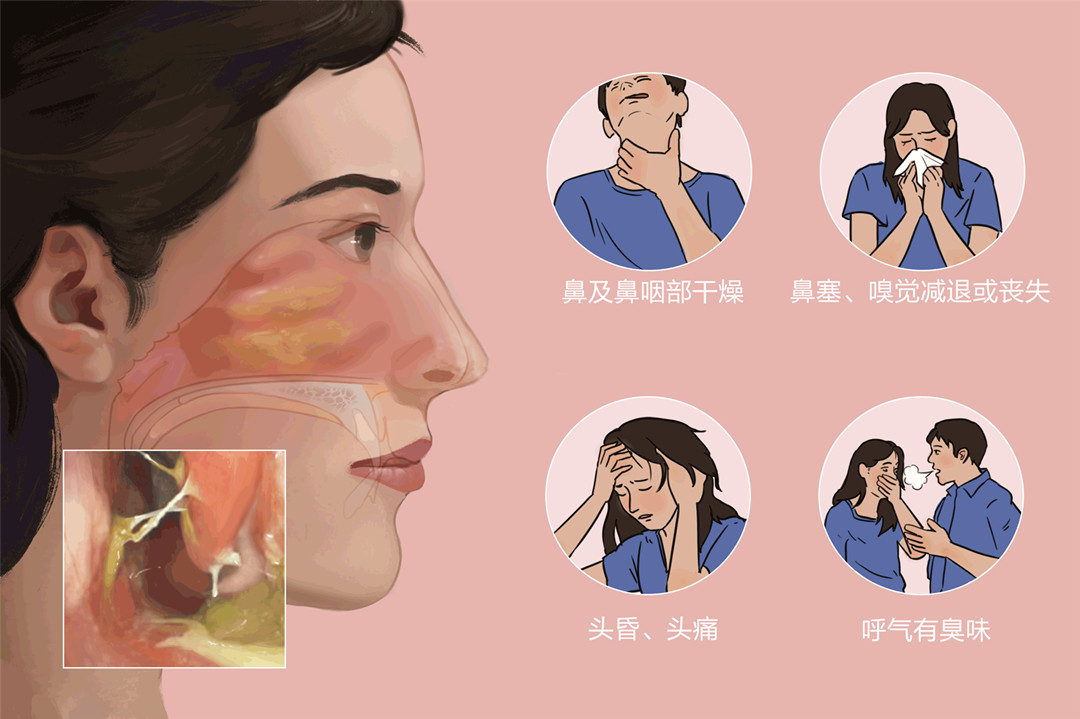 成都仁品耳鼻喉医院:预防鼻炎的“六要”与“六不要”