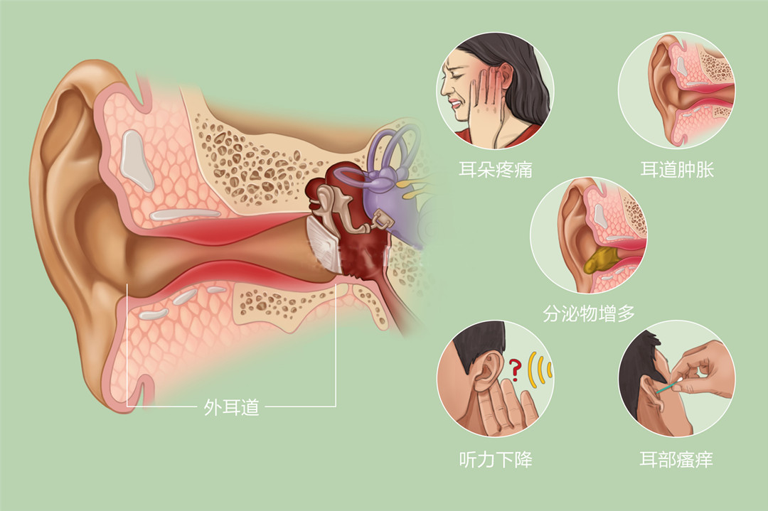 成都急性外耳道炎症状_成都耳鼻喉科医院